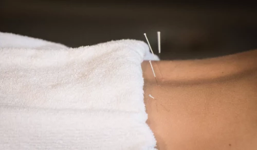 Acupuncture Treatment Near Me