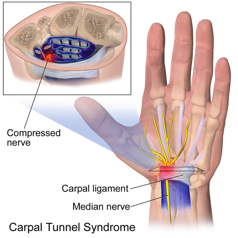 Carpal Tunnel Syndrome Oakville