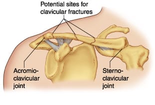 Clavicular Fractures Treatment