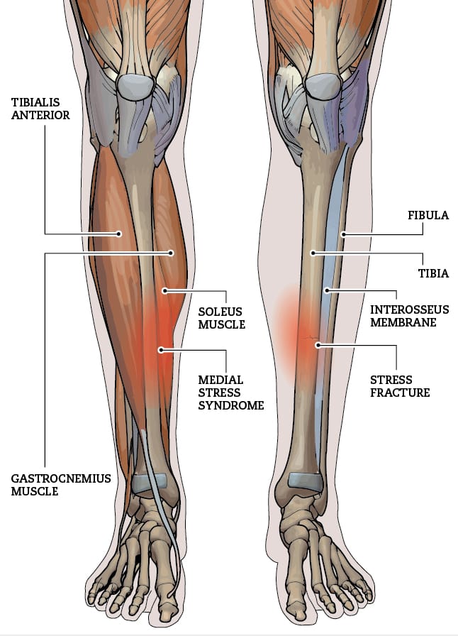 Tibial Stress Fractures in Runners