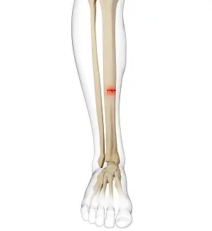 Tibial Stress Fractures