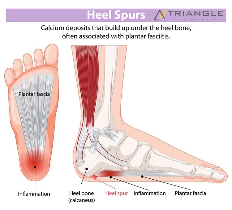 Heel Spur Treatment Toronto