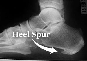 Heel Spurs Treatment Toronto