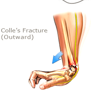 Colle's Fracture