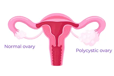 PCOS